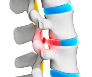 腰椎椎間板ヘルニアの原因、症状、診断、治療法、予防策