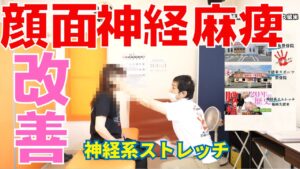 顔面神経麻痺のリハビリ（加療）はいつから？顔面神経麻痺が回復するまでの経過など福岡県久留米市より来院の患者様の例